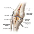 High Tibial Osteotomy (HTO)