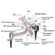 Functional Endoscopic Sinus Surgery (FESS: Draf II/III Frontal Sinusotomy)