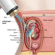 Extracorporeal Shock Wave Lithotripsy (ESWL)