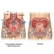 Double J Stent Placement or Percutaneous Nephrostomy