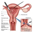 Hysteroscopic Selective Salpingography and Tubal Cannulation