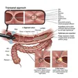 Colonoscopic Polypectomy (Cold/Hot Snare)