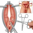 Cervical Polypectomy