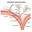Bartholin Gland Excision