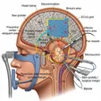 Awake Craniotomy with Functional Mapping and Maximal Safe Resection