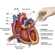 Pericardiectomy