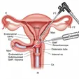 Hysteroscopic Resection of Submucosal Myoma