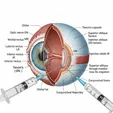 Extraocular Muscle Botulinum Toxin Injection