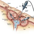 Third Ventriculostomy (ETV/CPC)