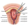 Energy-Assisted Excision (Radiofrequency/Laser)