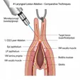 CO₂/Radiofrequency Minimally Invasive Removal