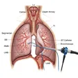 Bronchial Thermoplasty (BT)