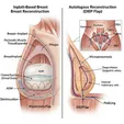 Breast Reconstruction (Implant/Autologous)