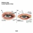 Entropion Repair (Rotational Sutures/Retractor Repair)