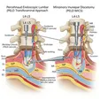 Endoscopic Discectomy (PELD/UBE)