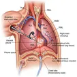 Thoracoscopic Lung Volume Reduction Surgery (LVRS)