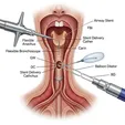 Airway Stent Placement