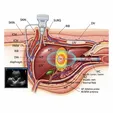 Image-Guided Ablation (RFA/MWA)