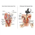 Lateral Femoral Cutaneous Nerve Decompression (Minimally Invasive/Endoscopic)