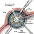Anterior Segment Microsurgical Membrane Removal/Adhesion Release