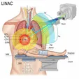 Palliative Radiotherapy (including SBRT)