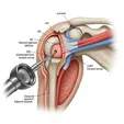 Arthroscopic Capsular Release