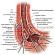Aortic Valve Repair