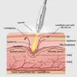 Pulsed Dye Laser (PDL) Treatment