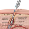Long-Pulsed 1064nm Nd:YAG Laser Treatment