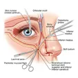 External Dacryocystorhinostomy (External DCR)