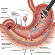 Endoscopic Mucosal Resection/Submucosal Dissection (EMR/ESD)
