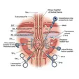 Laparoscopic Repair of Linea Alba Hernia