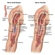 Microsurgical Nerve Repair/Graft/Transfer