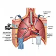 Thoracoscopic (VATS) Surgical Lung Biopsy
