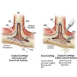 Lesion Curettage + Bone Graft/Bone Cement Filling