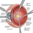 Minimally Invasive Vitrectomy Surgery (MIVS) + Epiretinal Membrane (ERM/Proliferative Membrane) Peeling