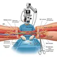 Microsurgical Exploration and Repair/Grafting