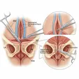 Posterior Colporrhaphy + Perineoplasty