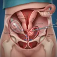 Ovarian Cystectomy