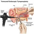 Endoscopic Transcanal Tympanoplasty