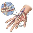 Polydactyly Excision + Ligament/Tendon/Flap Reconstruction