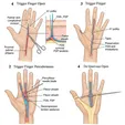 A1 Pulley Release or First Dorsal Compartment Release (Minimally Invasive/Open)