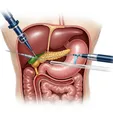 ERCP with Sphincterotomy + Stent Placement
