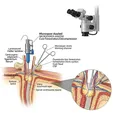 Microsurgical/Endoscopic Resection or Fenestration of Spinal Canal Cyst