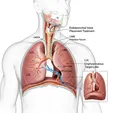 Bronchoscopic Lung Volume Reduction (BLVR - One-Way Valves, etc.)