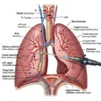 Endobronchial Valve (EBV)