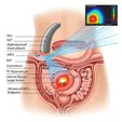 High-Intensity Focused Ultrasound Ablation (HIFU)