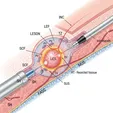 Laser Minimally Invasive Resection