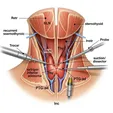 Minimally Invasive Parathyroidectomy (MIP)
