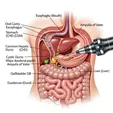 ERCP Stone Extraction